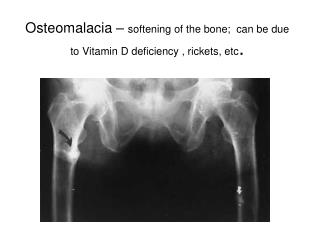 Osteomalacia – softening of the bone; can be due to Vitamin D deficiency , rickets, etc .