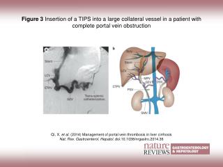 Qi, X. et al. (2014) Management of portal vein thrombosis in liver cirrhosis