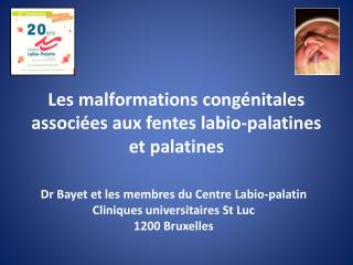 Les malformations congénitales associées aux fentes labio-palatines et palatines