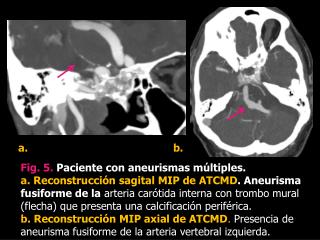 Fig. 5 . Paciente con aneurismas múltiples.