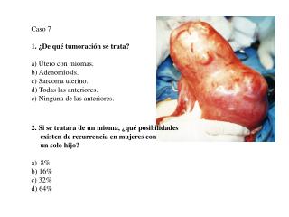 Caso 7 1. ¿De qué tumoración se trata? a) Útero con miomas. b) Adenomiosis. c) Sarcoma uterino.