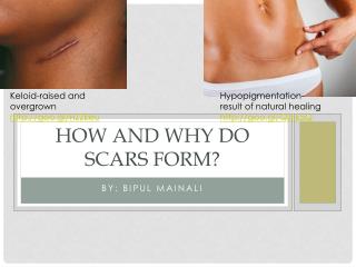 How and why do scars form?