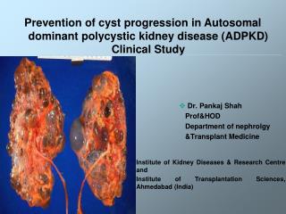 Dr. Pankaj Shah Prof&amp;HOD Department of nephrolgy &amp;Transplant Medicine