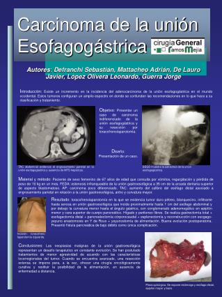 Carcinoma de la unión Esofagogástrica