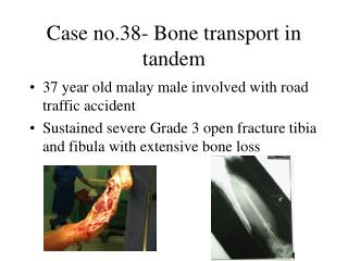 Case no.38- Bone transport in tandem