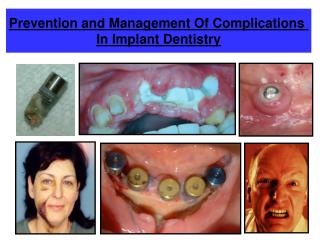 Prevention and Management Of Complications In Implant Dentistry