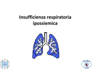 Insufficienza respiratoria ipossiemica