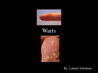 Warts