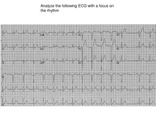 Analyze the following ECG with a focus on the rhythm