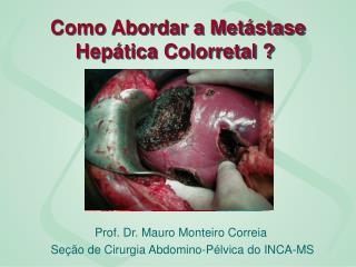 Como Abordar a Metástase Hepática Colorretal ?