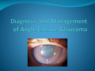 Diagnosis and Management of Angle Closure Glaucoma