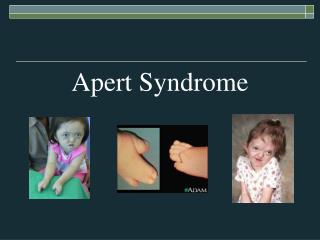 Apert Syndrome