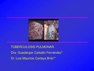 TUBERCULOSIS PULMONAR. Dra. Guadalupe Carballo Fernández* Dr. Luis Mauricio Cartaya Brito**
