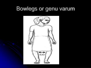 Bowlegs or genu varum