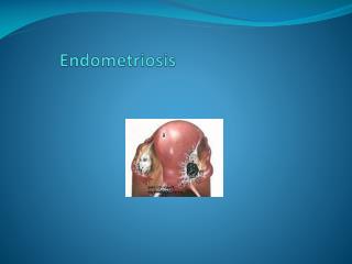 Presence of endometrial tissue (glands &amp; stroma ) outside the uterus