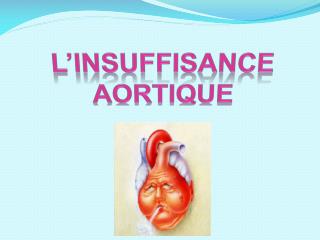 L’INSUFFISANCE AORTIQUE