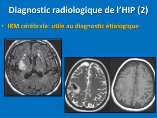 Diagnostic radiologique de l’HIP (2)