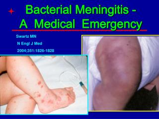 Bacterial Meningitis - A Medical Emergency