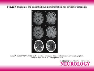 Figure 1 Images of the patient's brain demonstrating her clinical progression