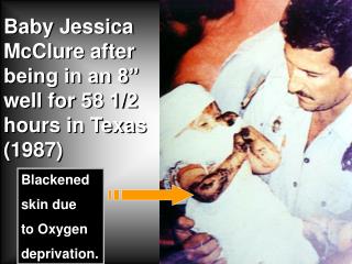 Baby Jessica McClure after being in an 8” well for 58 1/2 hours in Texas (1987)