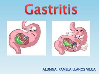 gastritis presentation