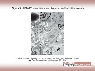 Figure 5 UHMWPE wear debris are phagocytosed by infiltrating cells