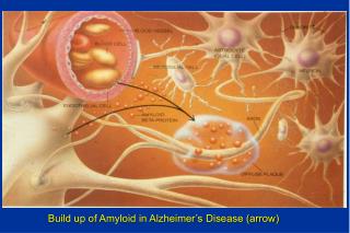 Build up of Amyloid in Alzheimer’s Disease (arrow)