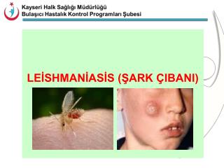 LEİSHMANİASİS (ŞARK ÇIBANI)