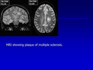 MRI showing plaque of multiple sclerosis.