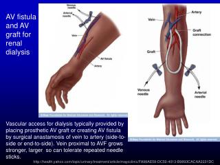 AV fistula and AV graft for renal dialysis