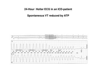 24-Hour Holter ECG in an ICD-patient Spontaneous VT reduced by ATP