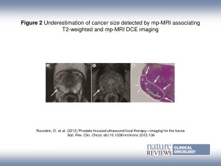 Rouvière, O. et al . ( 2012) Prostate focused ultrasound focal therapy—imaging for the future