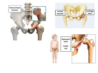 normal hip joint