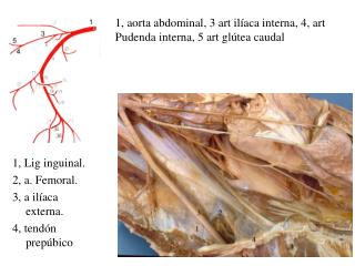 1, Lig inguinal. 2, a. Femoral. 3, a ilíaca externa. 4, tendón prepúbico