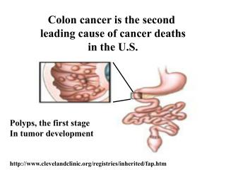 Colon cancer is the second leading cause of cancer deaths in the U.S.