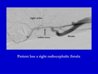 Patient has a right radiocephalic fistula
