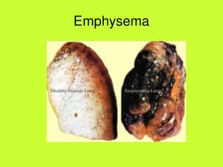 Emphysema