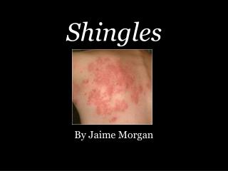 Shingles