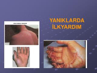 YANIKLARDA İLKYARDIM