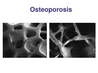 Osteoporosis