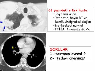 61 yaşındaki erkek hasta Sağ omuz ağrısı Üst batın, beyin BT ve kemik sintigrafisi olağan