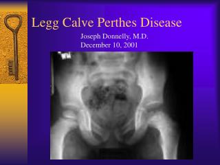 Legg Calve Perthes Disease