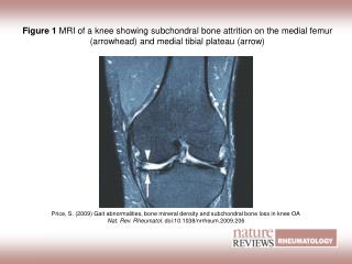 Price, S. (2009) Gait abnormalities, bone mineral density and subchondral bone loss in knee OA