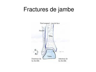 Fractures de jambe