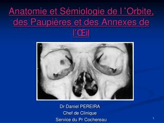 Anatomie et Sémiologie de l ‘ Orbite, des Paupières et des Annexes de l ’ Œil