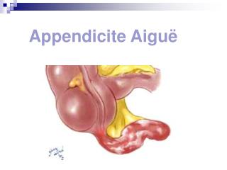 Appendicite Aiguë