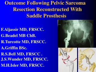 Outcome Following Pelvic Sarcoma 	Resection Reconstructed With 			 Saddle Prosthesis