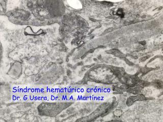 Síndrome hematúrico crónico Dr. G Usera, Dr. M.A. Martínez