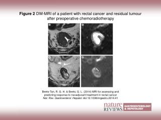 Figure 2 DW‑MRI of a patient with rectal cancer and residual tumour