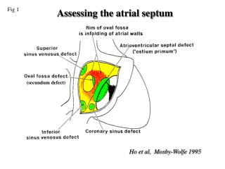 Assessing the atrial septum